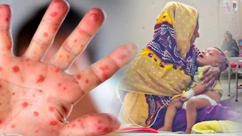 হাম উপসর্গে আরও ৭ জনের মৃত্যু